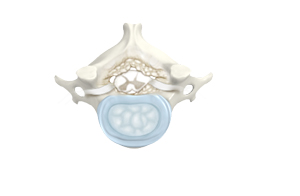 Cervical Stenosis