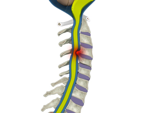 Cervical Myelopathy