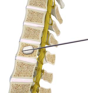 Kyphosis