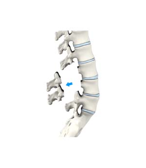 Lumbar Laminectomy