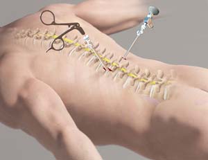 Minimally Invasive Spinal Surgery