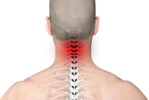 Chronic Neck Pain