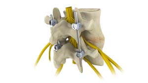 Cervical Spine Fusion