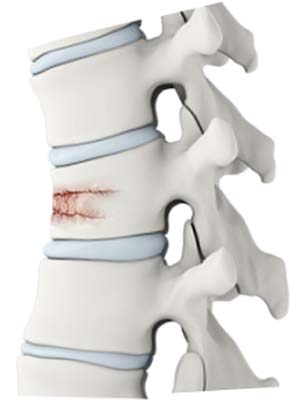 https://www.spineindy.com/3d-images/vertebral-fracture.jpg