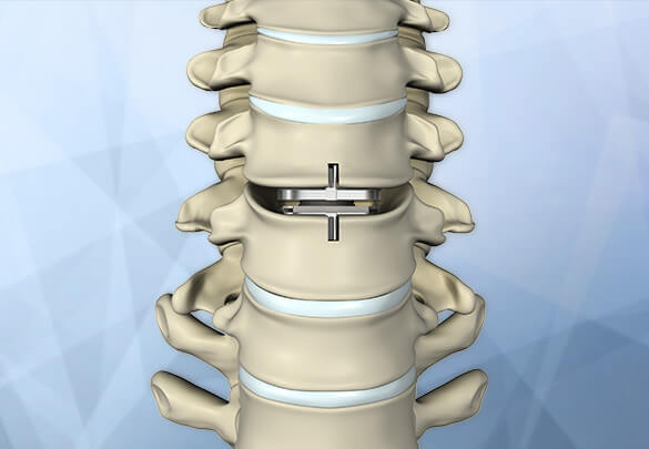 Cervical Disc Replacement