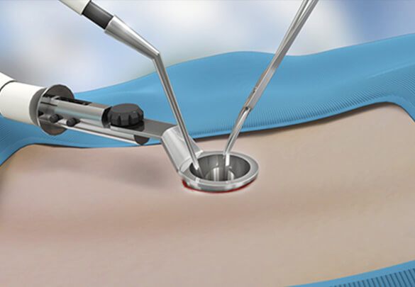 Minimally Invasive Spine Surgery